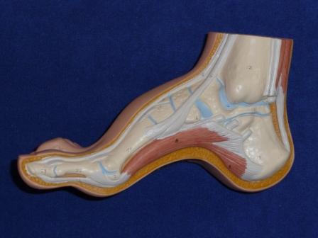 picture of excessive arched foot